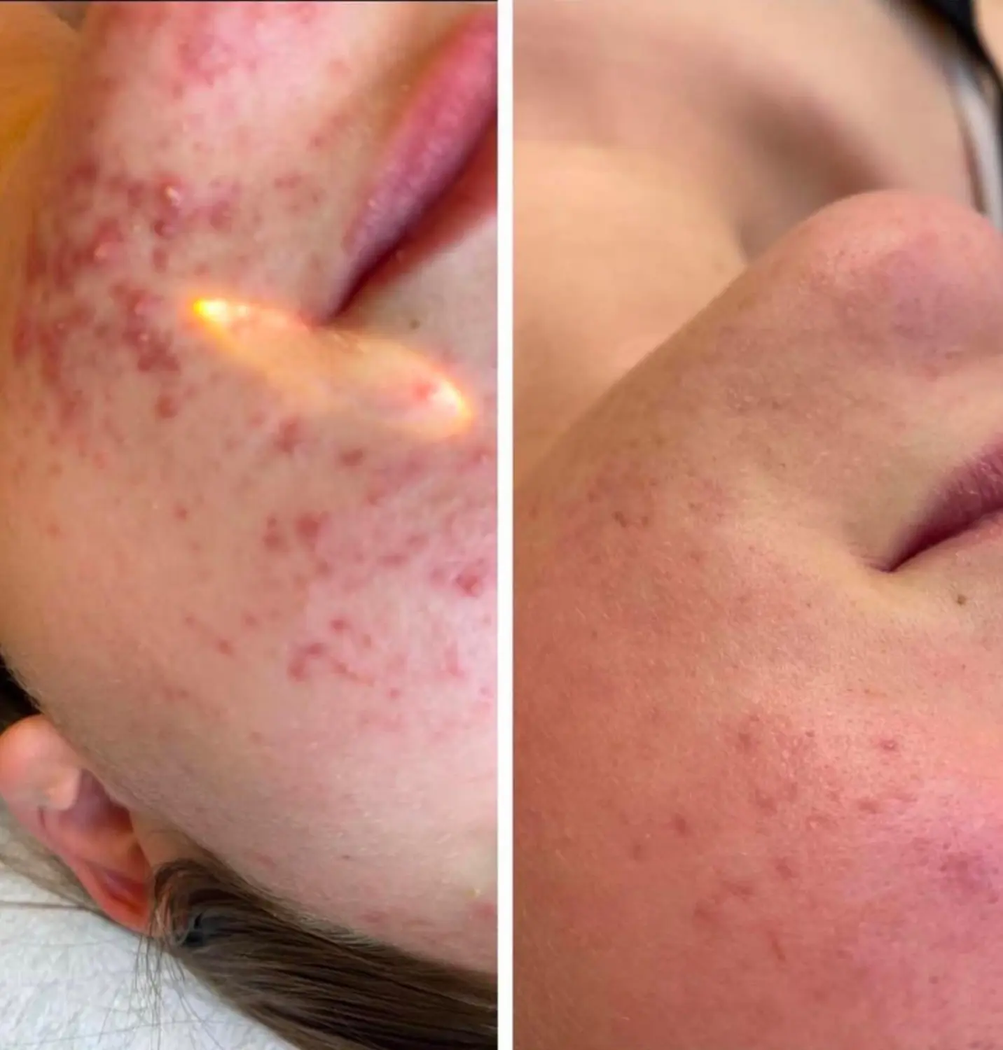 Akne im Gesicht von VS Kosmetik