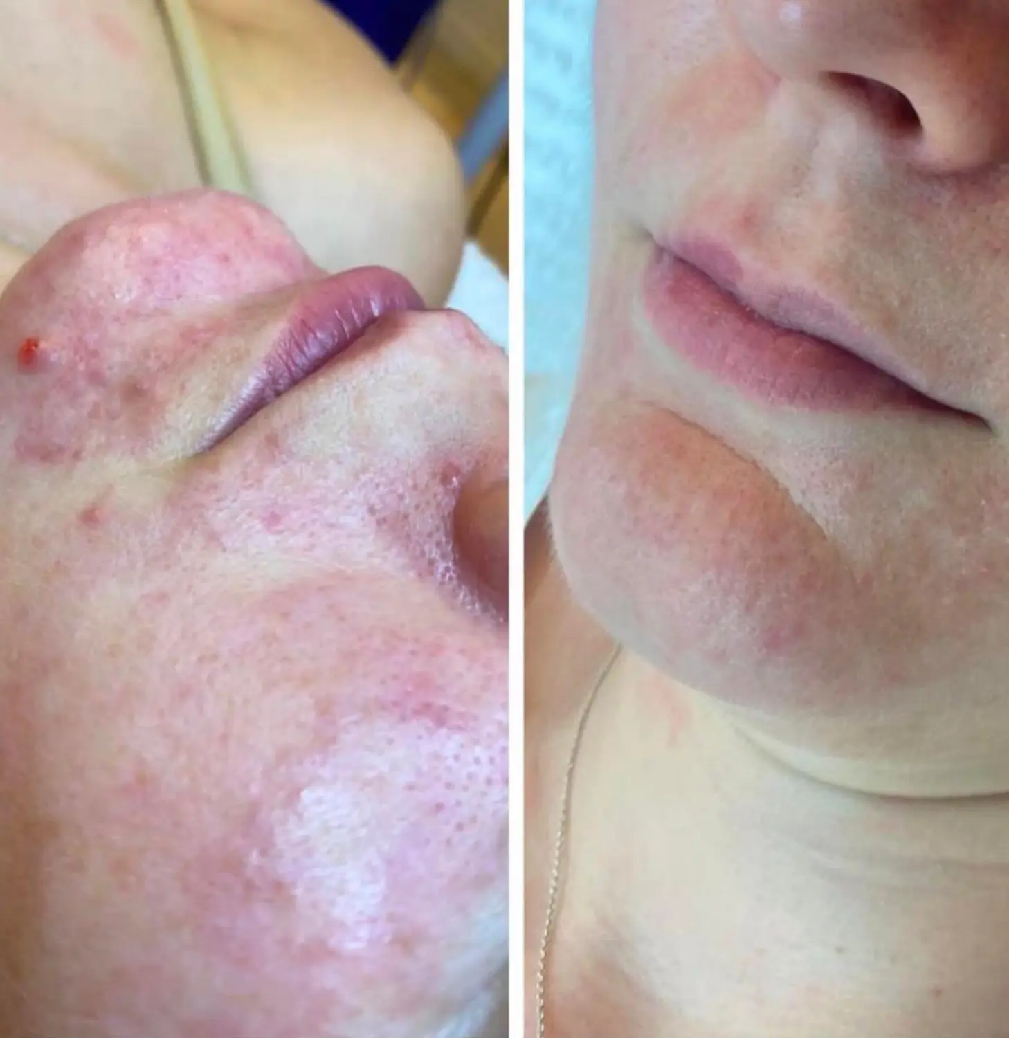 Akne im Gesicht von VS Kosmetik