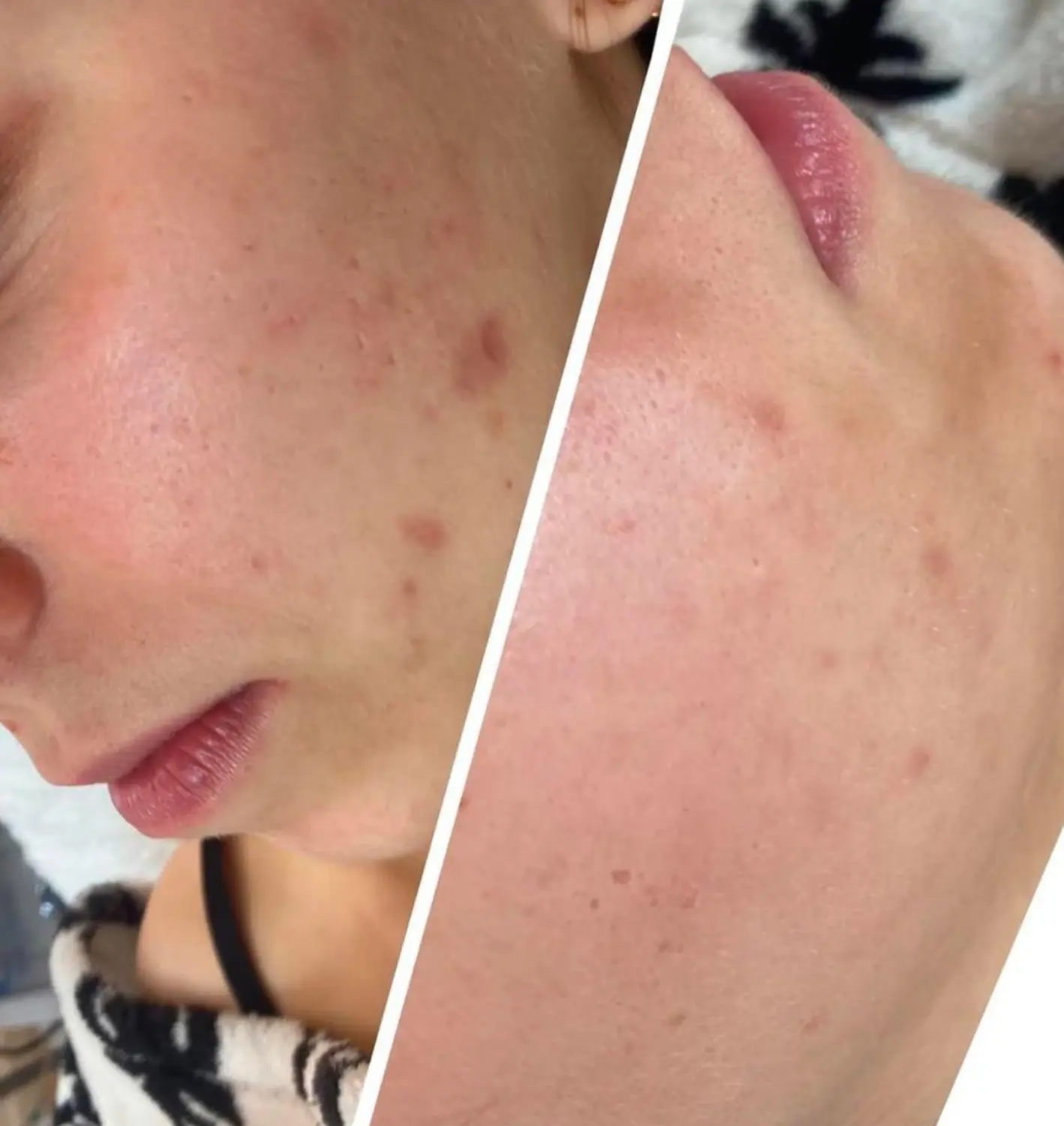 Akne im Gesicht von VS Kosmetik