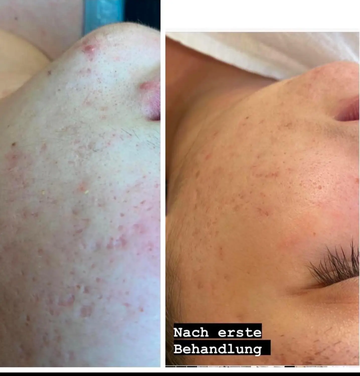 Akne im Gesicht von VS Kosmetik