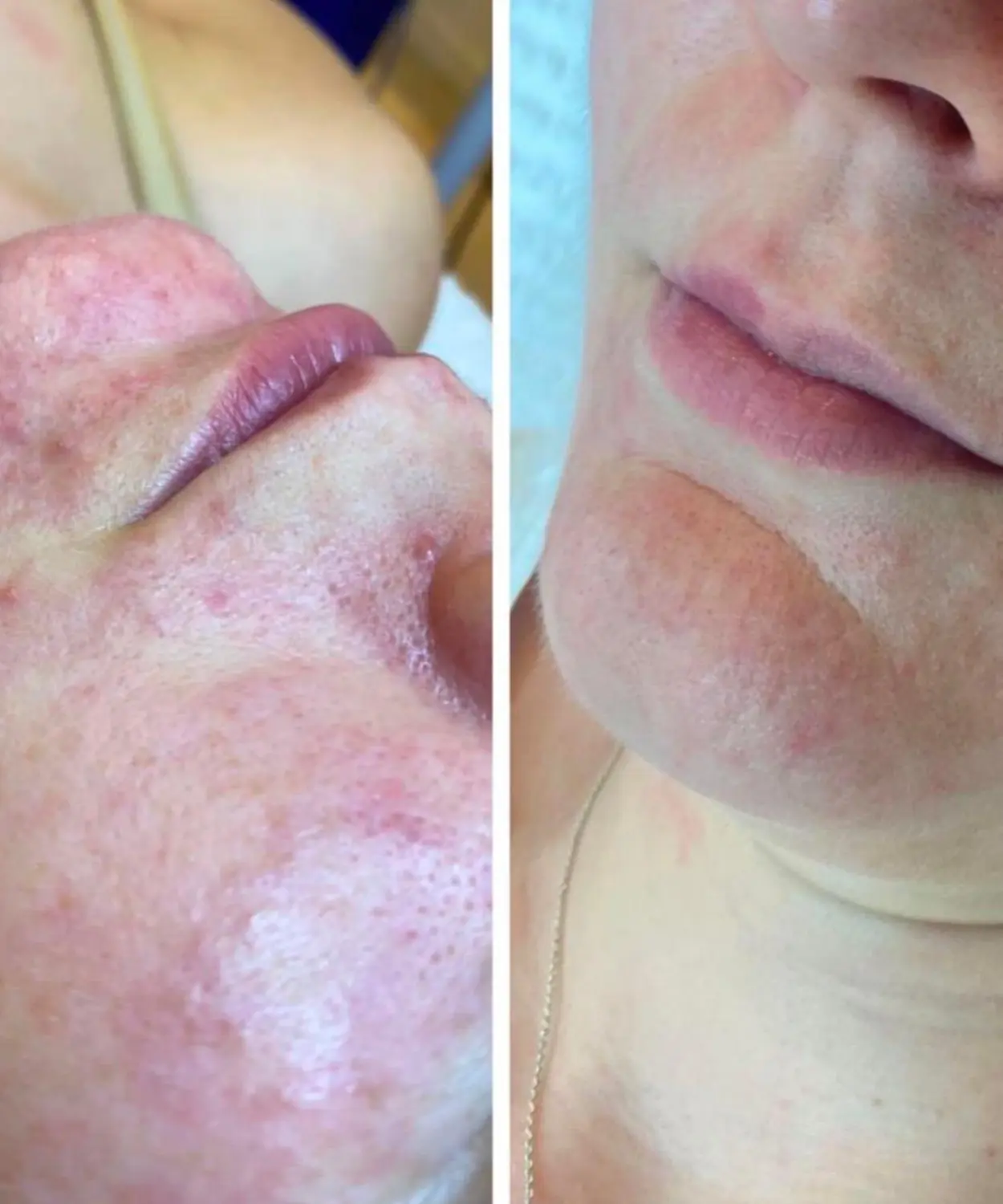 Akne im Gesicht von VS Kosmetik