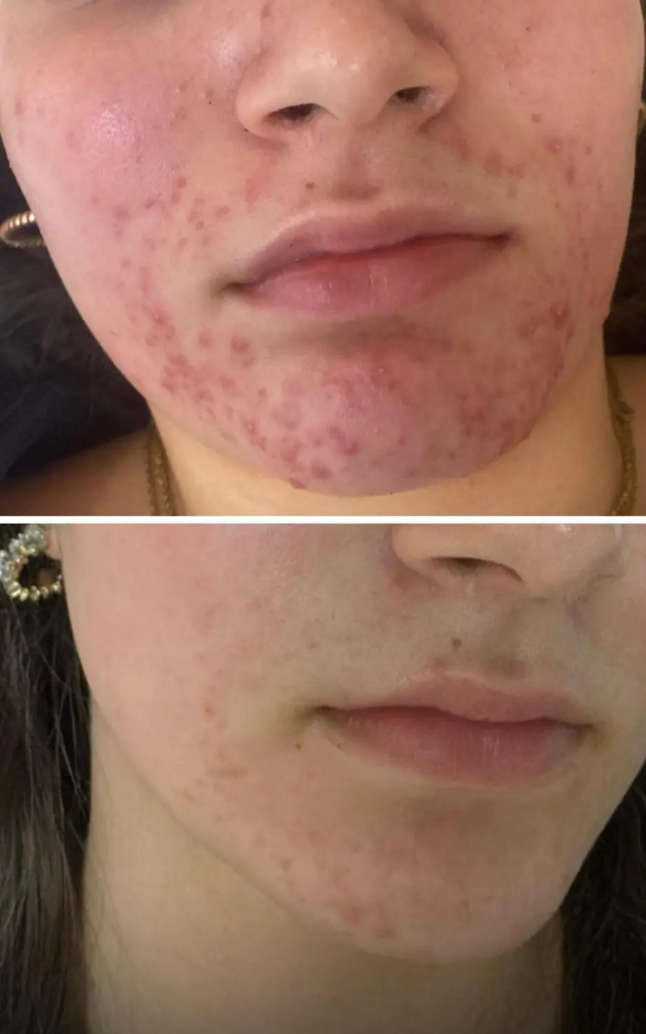 Akne im Gesicht von VS Kosmetik