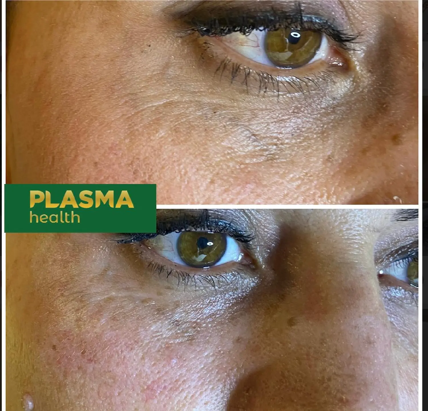 Kalte Plasma-Behandlung von VS Kosmetik