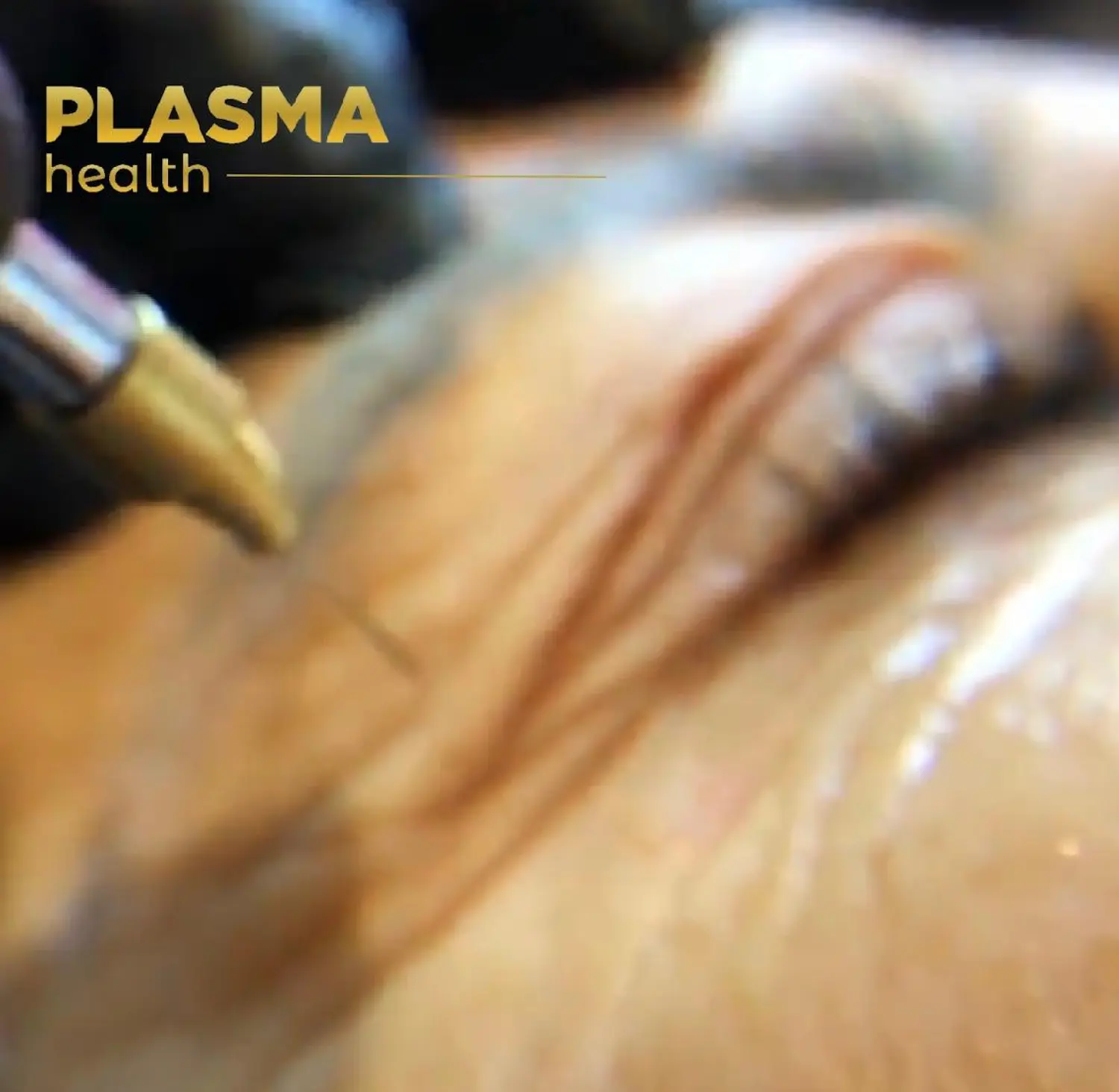 Kalte Plasma-Behandlung von VS Kosmetik