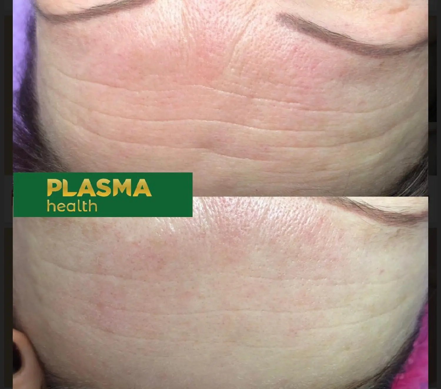 Kalte Plasma-Behandlung von VS Kosmetik