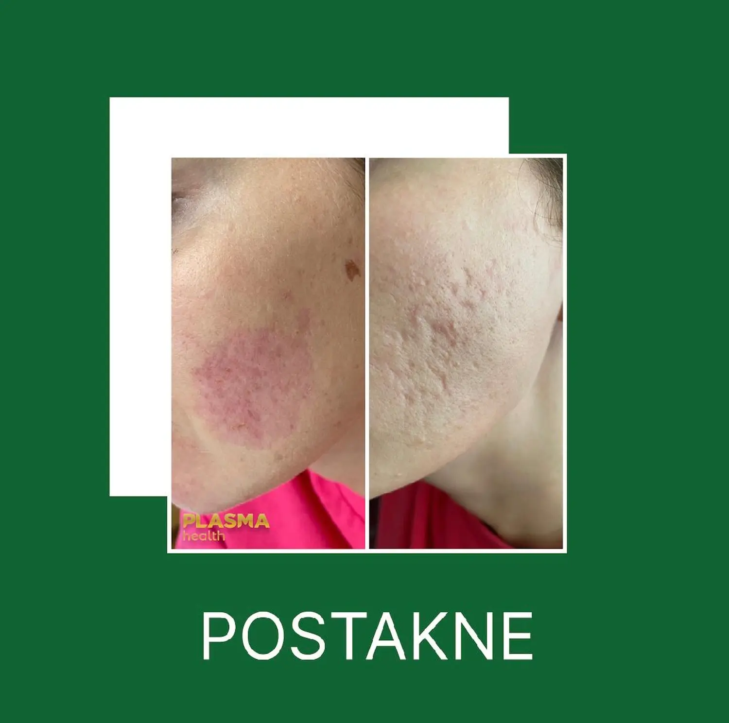 Kalte Plasma-Behandlung von VS Kosmetik