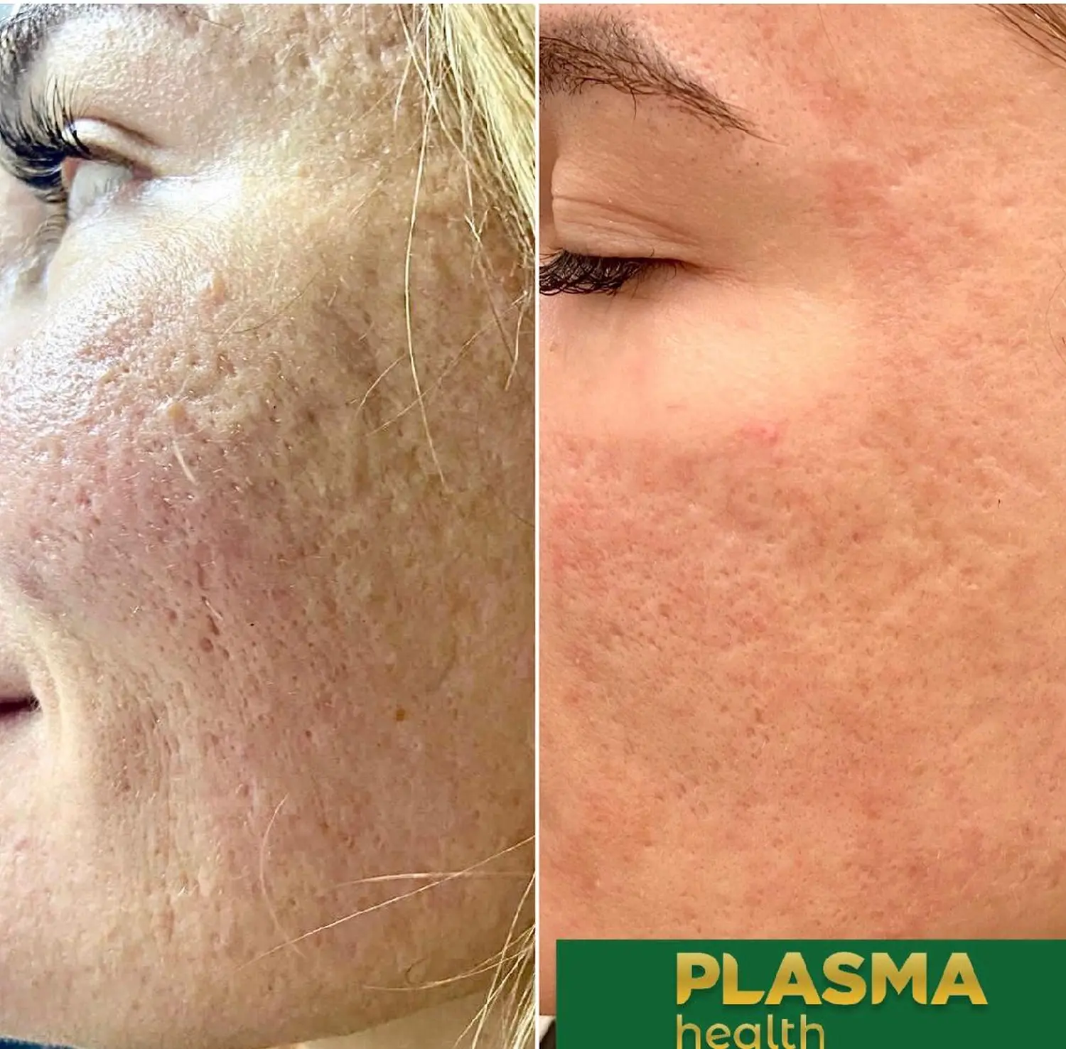 Kalte Plasma-Behandlung von VS Kosmetik